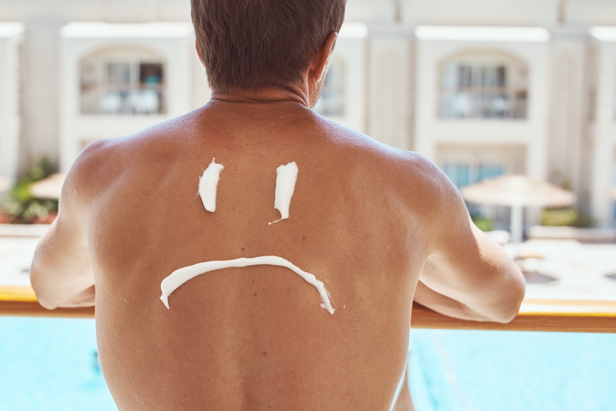 How to Effectively Treat Sunburns in No Time 